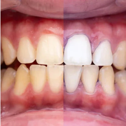 Blanqueador V34 Gluvydent