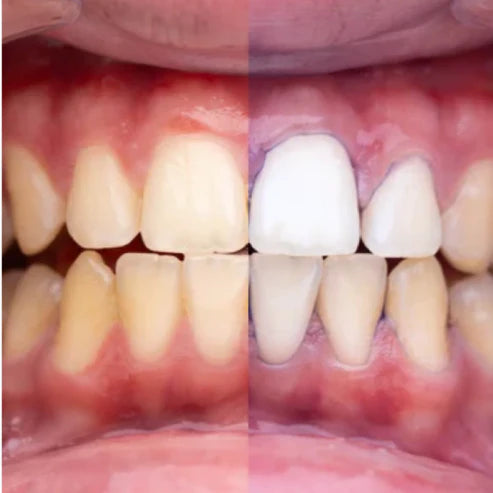 Blanqueador V34 Gluvydent